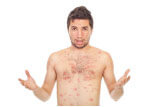 Skin disorders/eczema, psoriasis, dermatitis